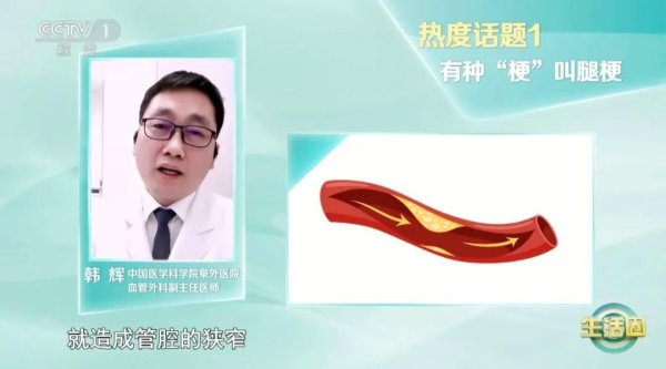 银河配资 血管堵没堵 走两步! 改掉这6个坏习惯让你的血管强大起来